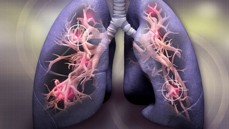 nghệ đen giảm viêm phổi