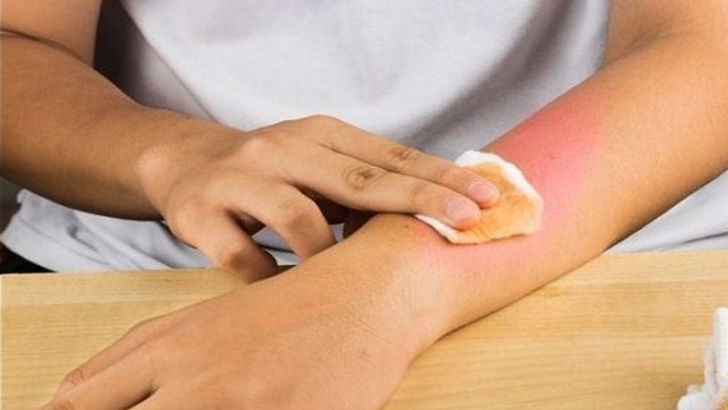 nghệ đen điều trị bỏng