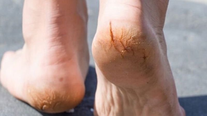 nghệ đen chữa nứt gót chân